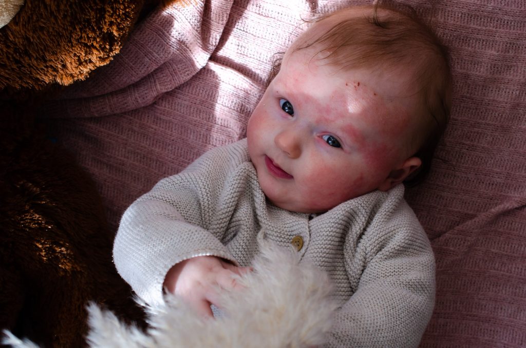 Lydia's eczema