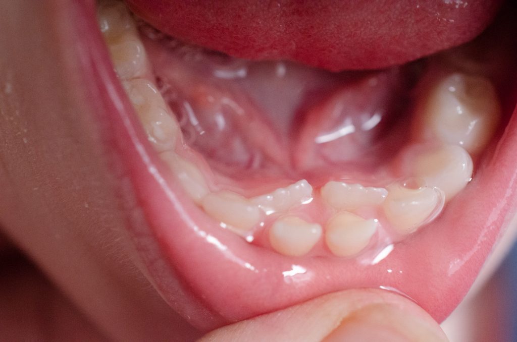New teeth! What fresh horror is this?