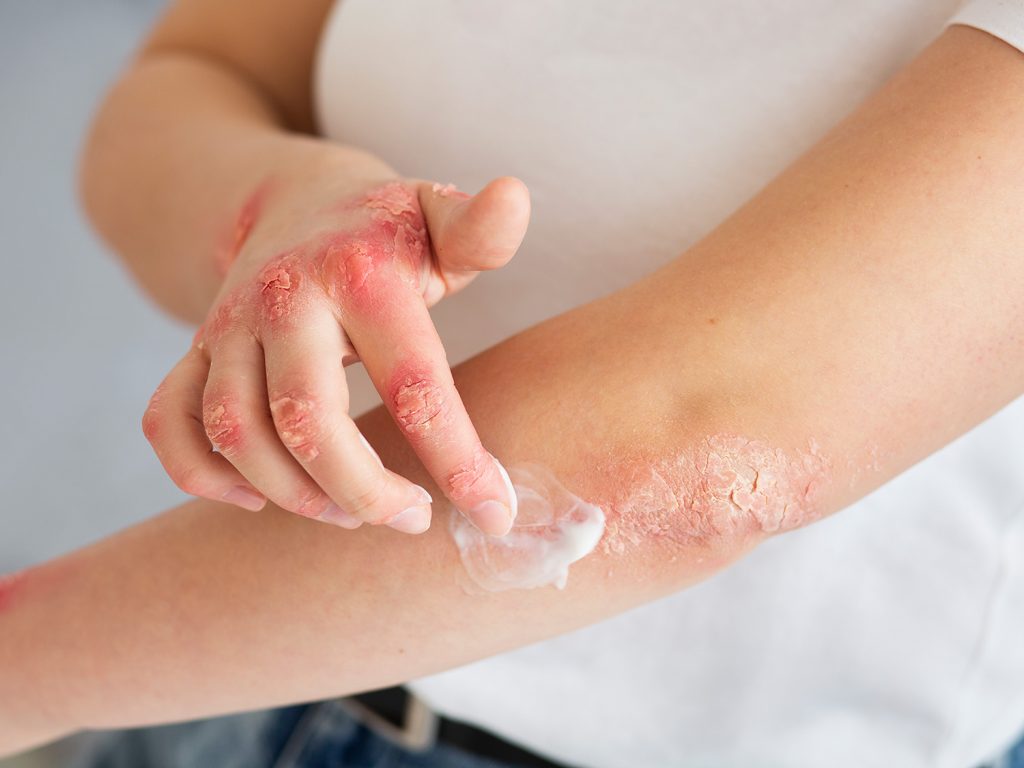 Psoriasis can worsen during pregnancy