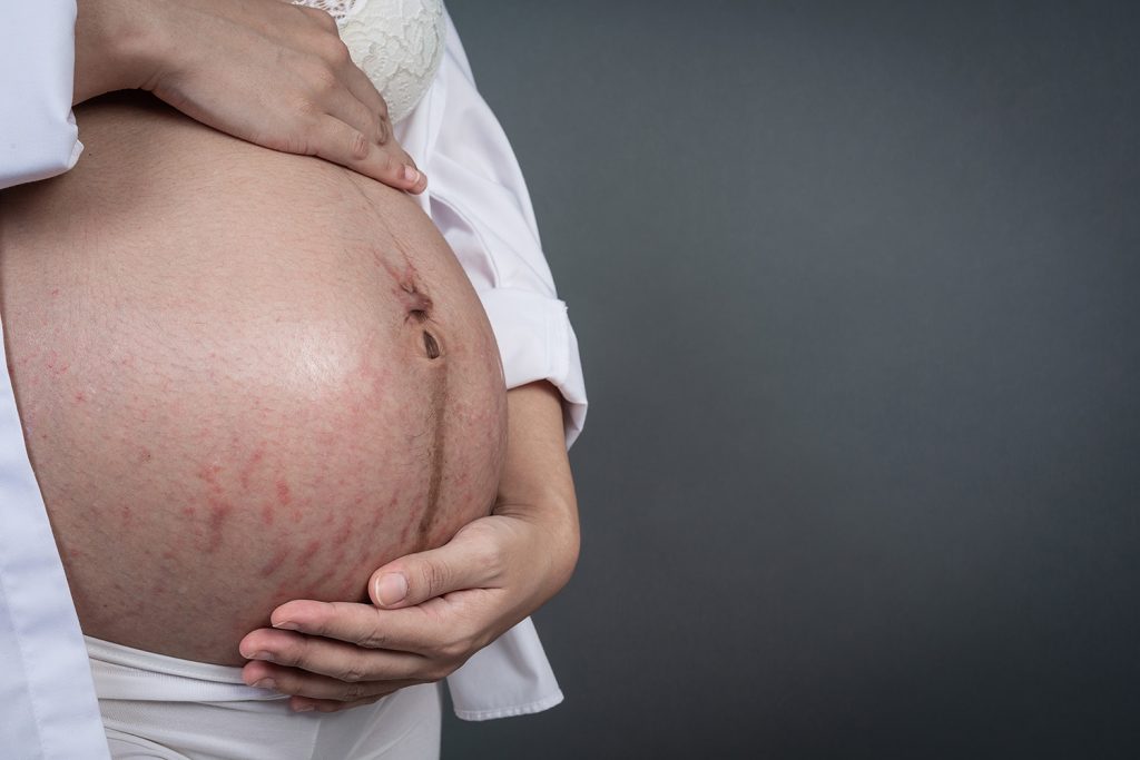 Stretch marks on pregnant belly