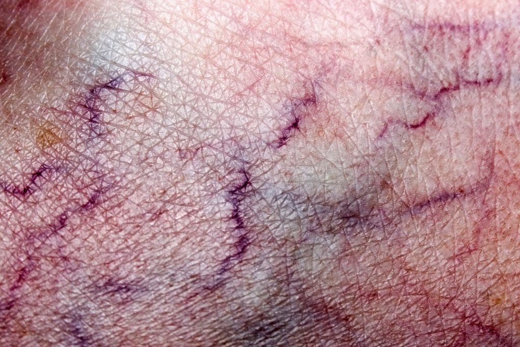 Dark thread veins before removal treatment