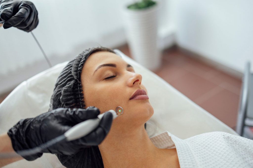 KTP laser treatment to remove facial veins