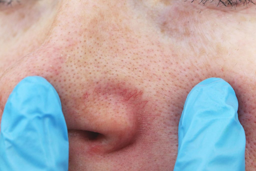 Red spider veins on the nose