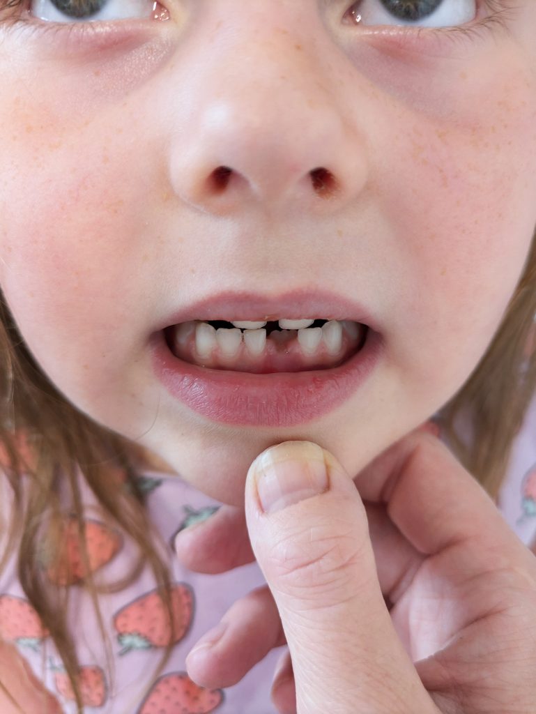 Cara's wobbly tooth